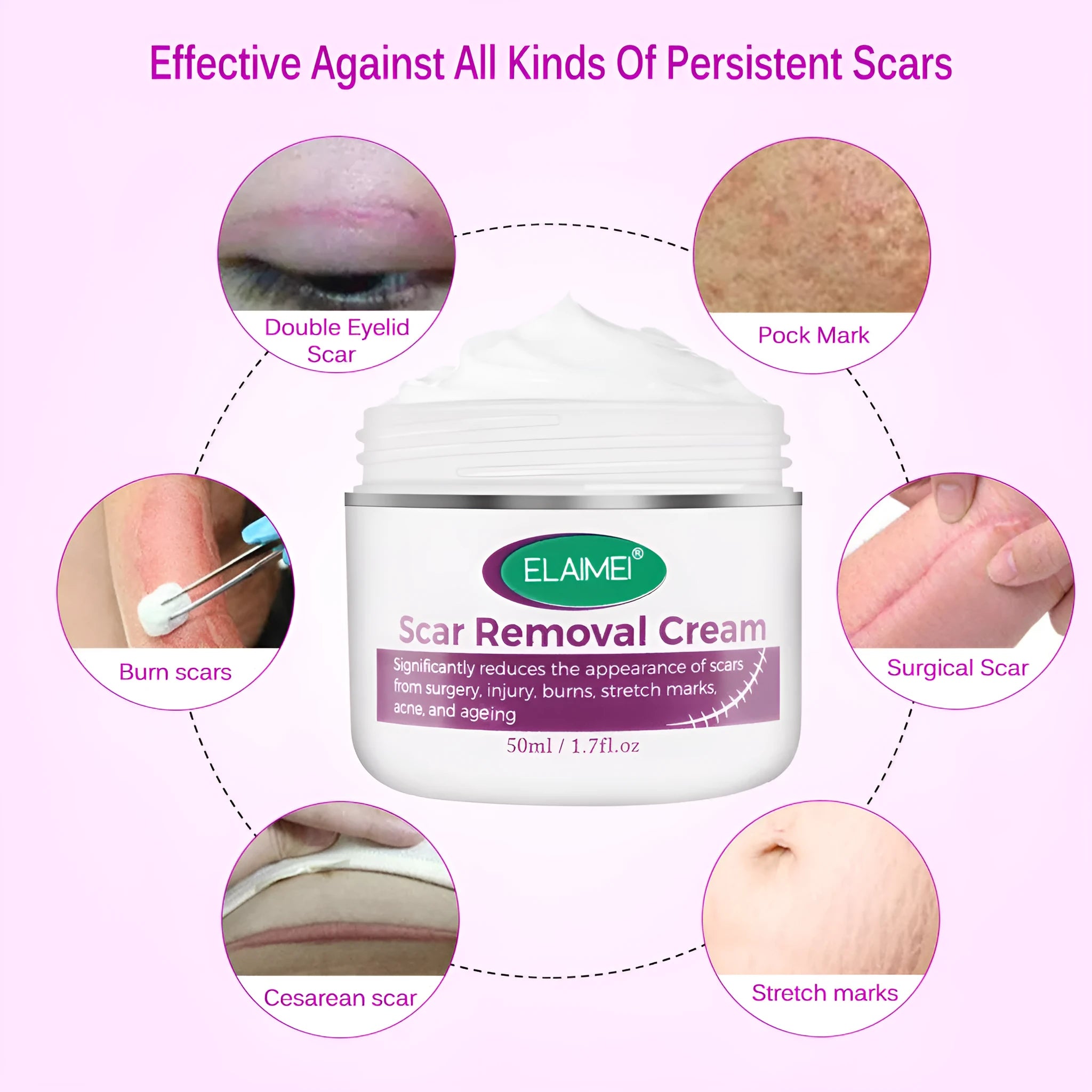 Skin Rebound Scarless Cream 50g tube for face acne scar and stretch mark removal