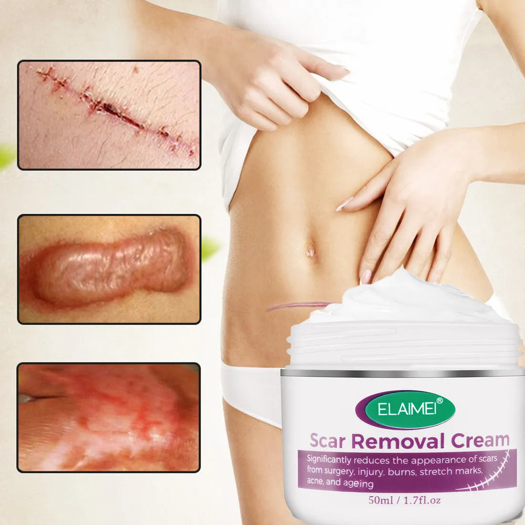 Skin Rebound Scarless Cream 50g tube for face acne scar and stretch mark removal