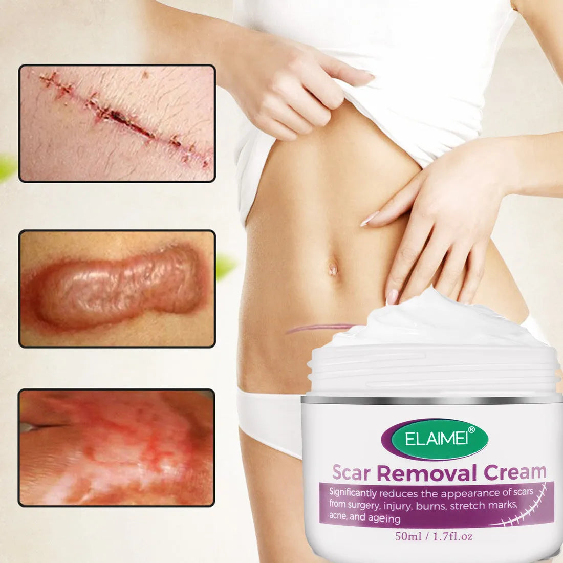 Skin Rebound Scarless Cream 50g tube for face acne scar and stretch mark removal