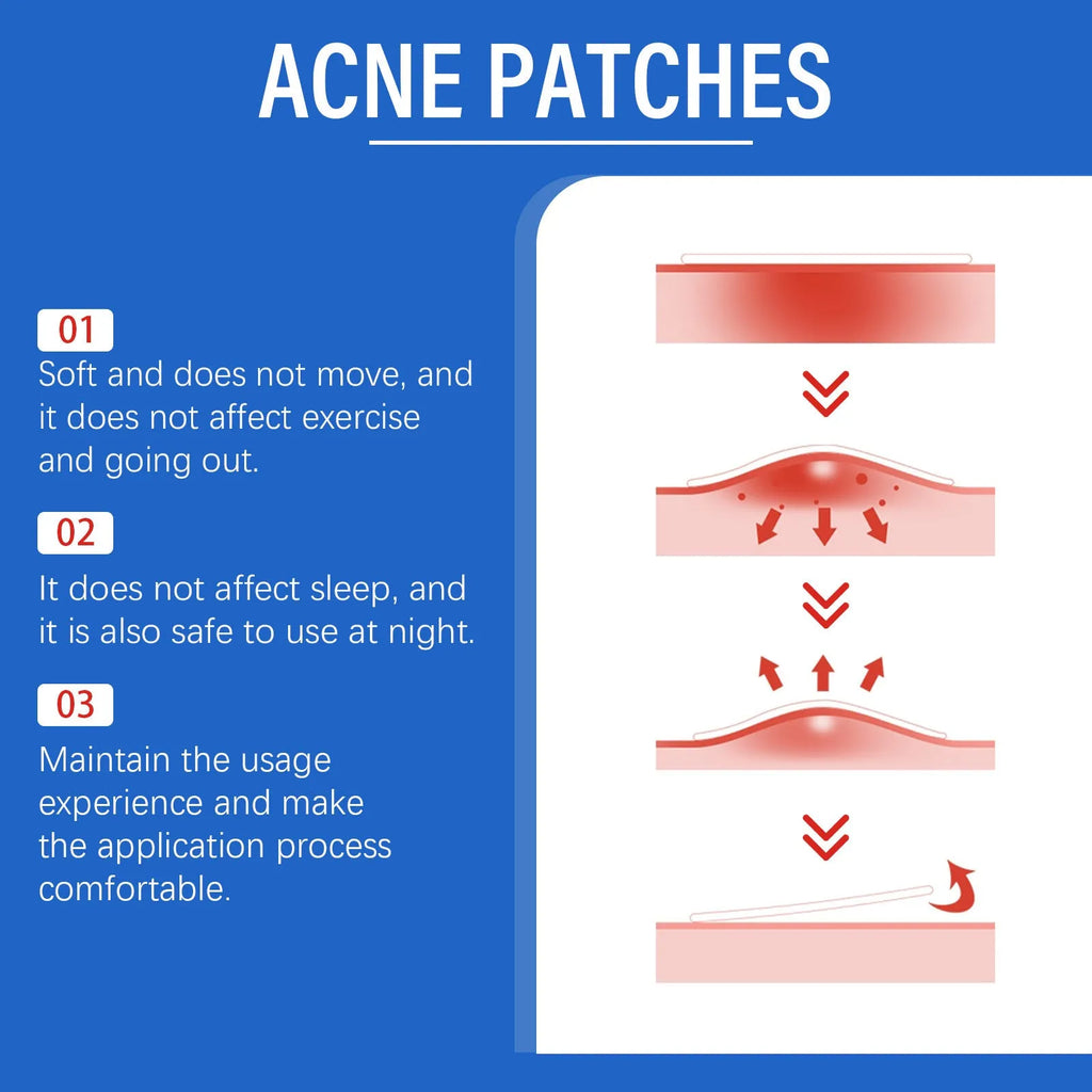Pack of 216 transparent hydrocolloid acne patches for spot treatment with tea tree oil and vitamin E.
