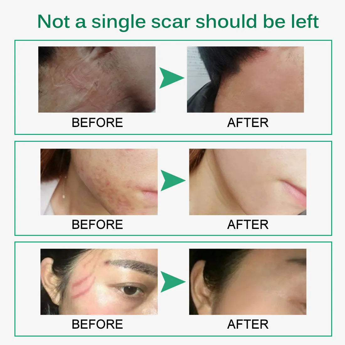 Skin Rebound Scarless Cream 50g tube for face acne scar and stretch mark removal